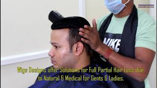 Non Surgical Hair Replacement in Hyderabad 9951223066