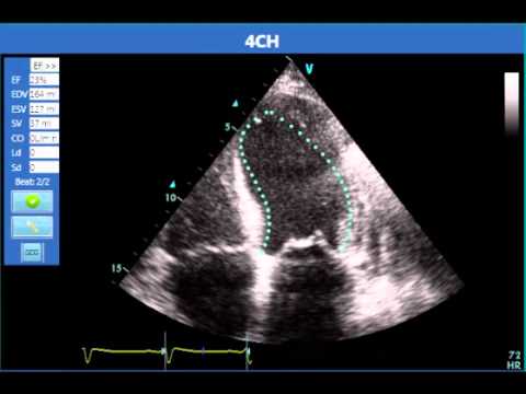 Automated EF Evaluation - Severe LV Function - YouTube