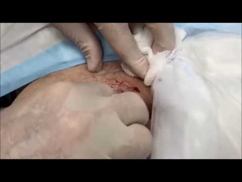 Video: Cyst Vs. Abscess: At Kende Forskellen