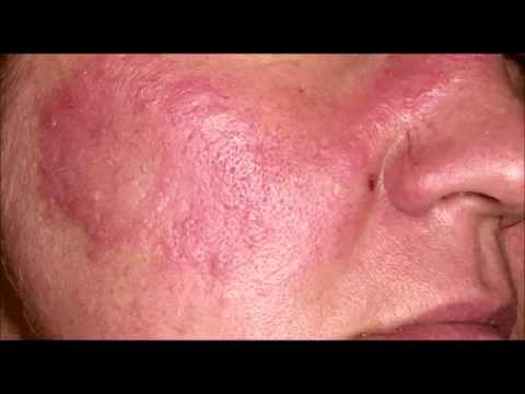 Vidéo: Cellules Souches Mésenchymateuses Pour Le Traitement Du Lupus érythémateux Disséminé: Le Remède Contre Les Maladies Du Tissu Conjonctif Dans Le Tissu Conjonctif?