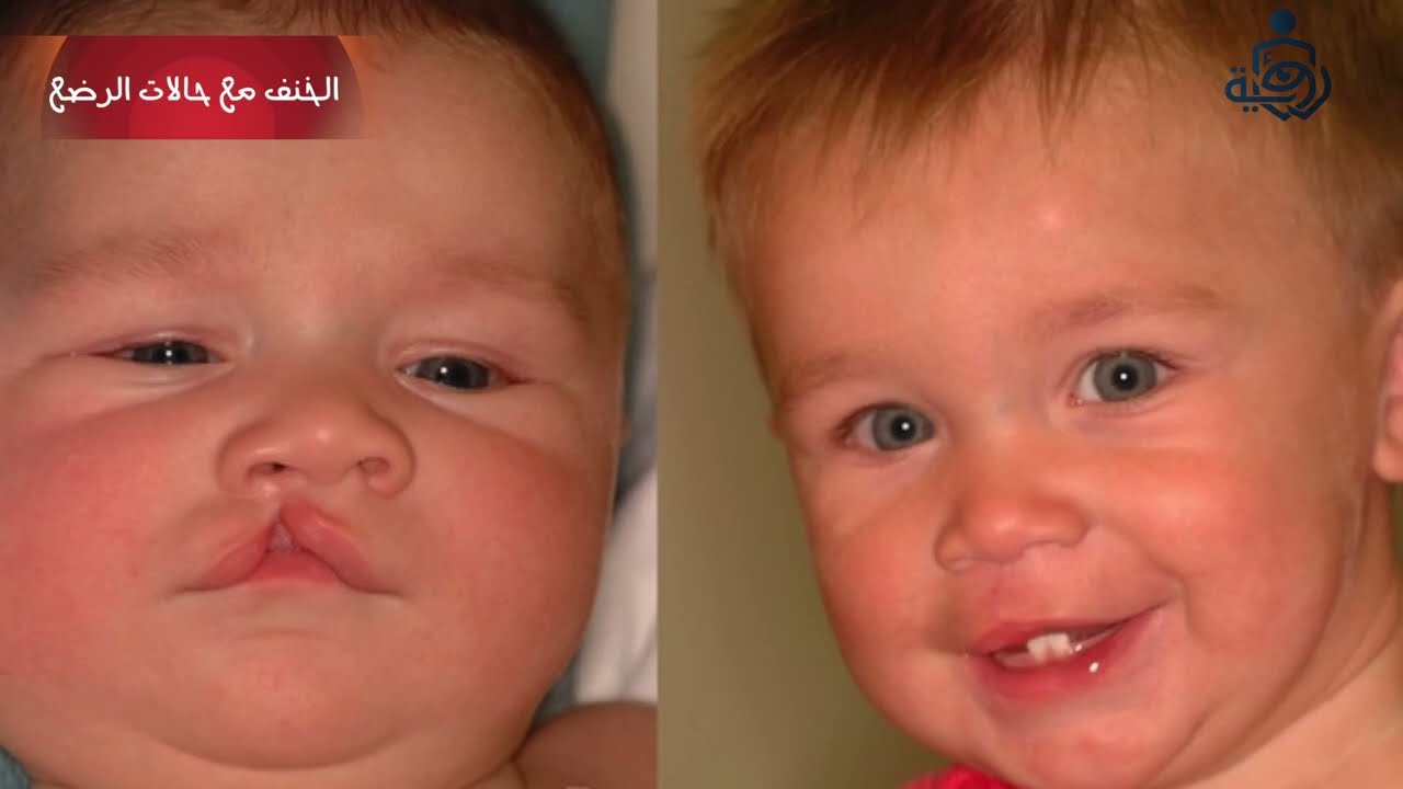 الخنف مع حالات الرضع