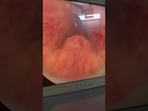 منظار المثانة البولية د على زيدان