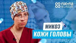 Микоз кожи головы: симптомы и лечение #облысение #микозкожи