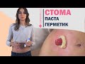 Обзор герметиков для стомы | Стерильно.com