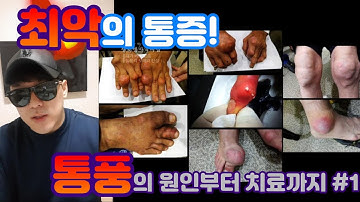 김종국도 앓는 통풍! 통풍의 원인부터 치료법까지 모두 알려드립니다.