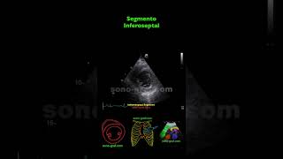 Ecocardiografía - Hipocinesia Inferolateral E Inferior