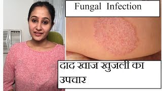 फ़ंगस इनफ़ेक्शन का इलाज || Treating Fungal Infection (In HINDI)|| DR.MADHURI ANANTWAR