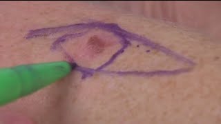 Skin Cancer Warning Signs What To Lookout For