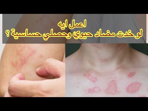 شاهد التصرف الصحيح ف حالة حدوث حساسية من مضاد حيوي