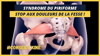 COMMENT SOIGNER SON SYNDROME DU PIRIFORME ? CONSEILS KINÉ !