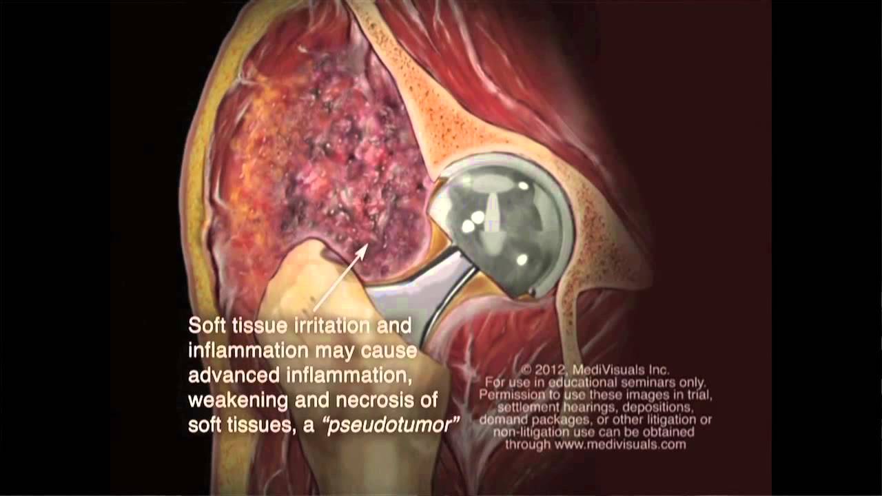 Cobalt And Chromium Hip Poisoning Youtube