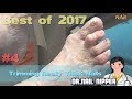 #4 Best of 2017 - Dr Nail Nipper  - Trimming Really Thick Nails in Podiatry office