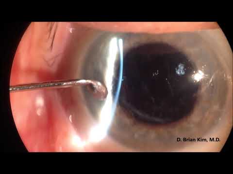 How Detect Occult Corneal Erosions: The Corneal Sweep Test