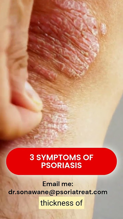 3 Key Psoriasis Symptoms You Need to Watch For