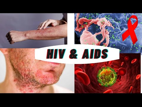 HIV and AIDS | how HIV becomes AIDS | symptoms, causes and prevention ...