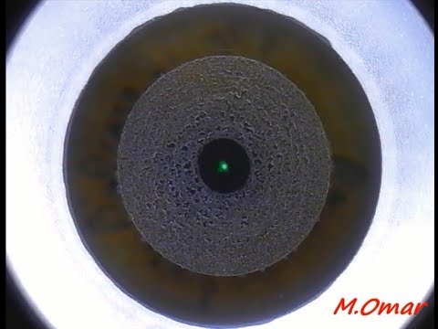 عملية الفمتوسميل لعلاج قصر النظر دكتور محمد عمر يوسف