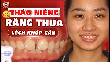 Thay Đổi Ngỡ Ngàng Sau Khi Tháo Niềng Răng Thưa, Sai Khớp Cắn Của Thu Hằng | Nha khoa Sdental