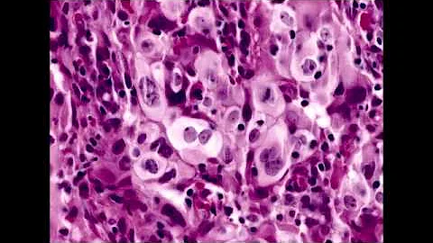 Large Cell Carcinoma of the Lung - DayDayNews
