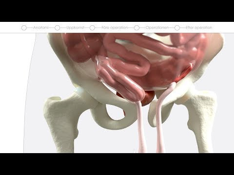 Video: Övningar För En Bråck I Livmoderhalsen Hemma