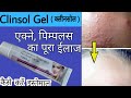 Clinsol Gel Review In Hindi | एक्ने, पिम्पलस ,ऑयली स्किन की असरदार दवा |