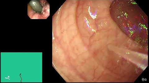 Endoscopy Top Tips: LGI - colonoscope insertion using the water immersion technique