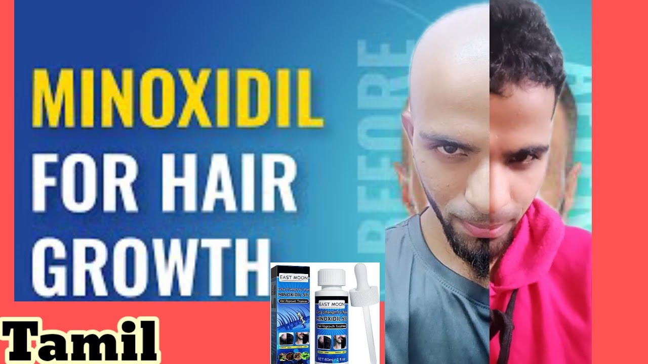 minoxidil for hair regrowth{result}{Ameerfonsi/தமிழில்