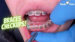 Braces Checkup - 9 months progress- Changing lower wire - Tooth Time Family Dentistry New Braunfels