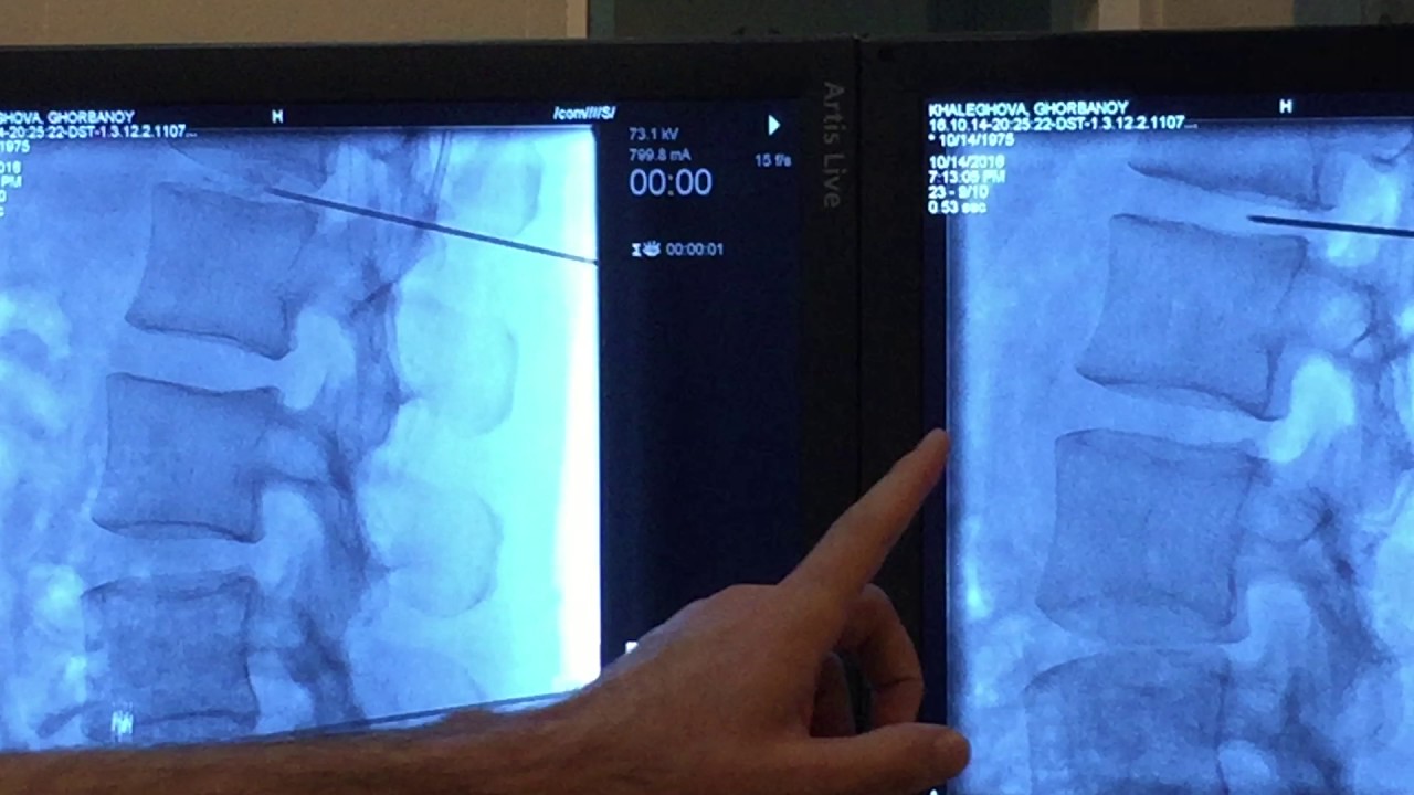 Discogel a new innovative treatment for minimal invasive spinal disc