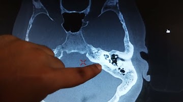 HRCT Temporal Bone Anatomy as per Reporting format By Gaurav Rawat