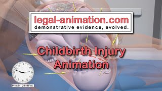 Childbirth Injury Animation. Forensic animation created for Jim M. Perdue, Jr.  Medical Animation.