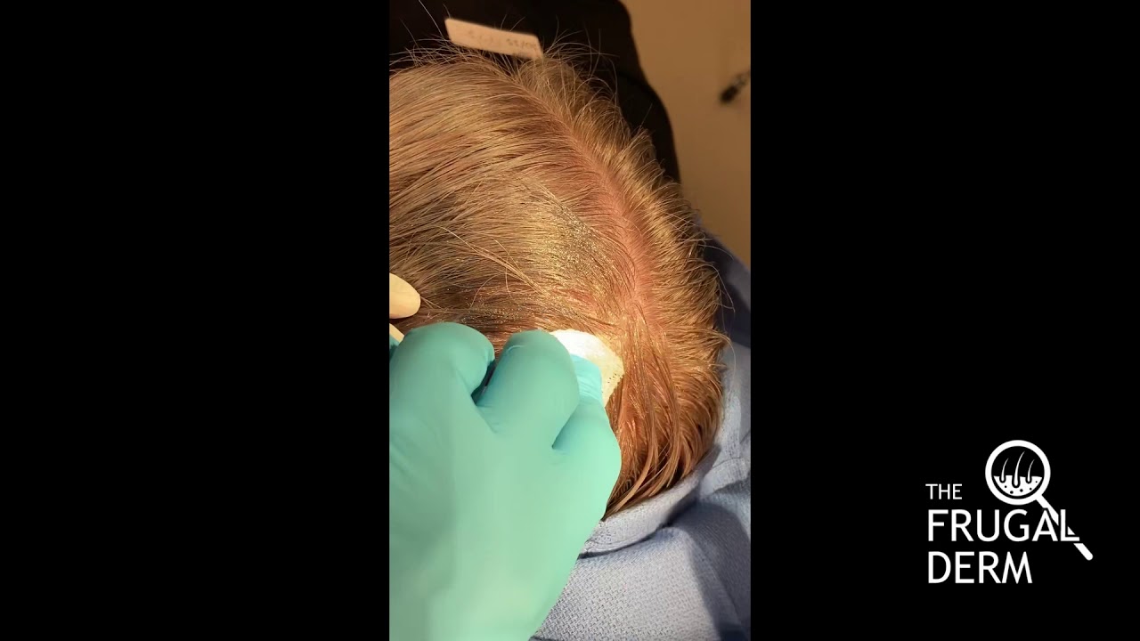 Pilar Cyst On The Scalp Youtube