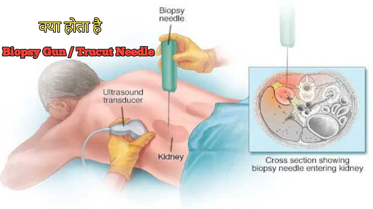 Как берут биопсию у мужчин. Чрескожная пункционная биопсия почки. Техника пункционная биопсию почки. Чрескожная биопсия опухоли почки.