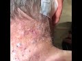 Blackhead on body satisfying gross