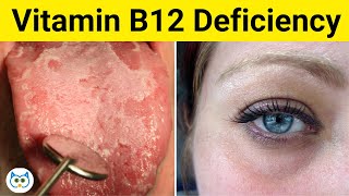 Vitamin B12 Deficiency Symptoms You Should Not Ignore