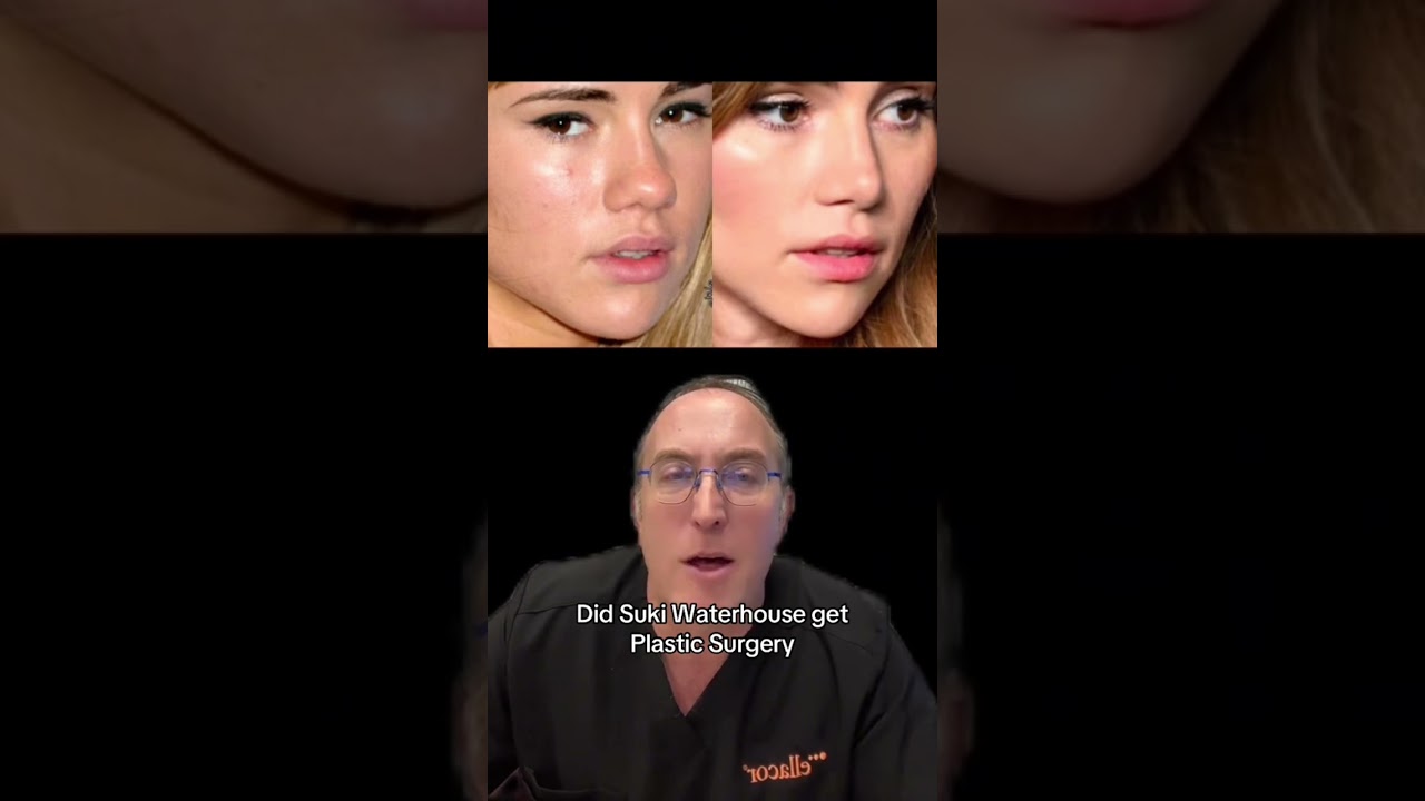 Suki Waterhouse’s Transformation Explained by Facial Plastic Surgeon