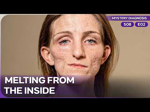 The Disease That Erased Half a Teenage Girls Face | Mystery Diagnosis