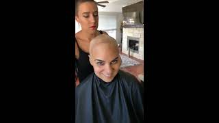 Post Radiation Head Shaving after removing an Avocado Sized Glioblastoma (GBM) Brain Tumor