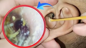 WARNING: Deep, Infected Earwax Removal That Will Shock You | ASMR Ear Cleaning USA | Ep 189