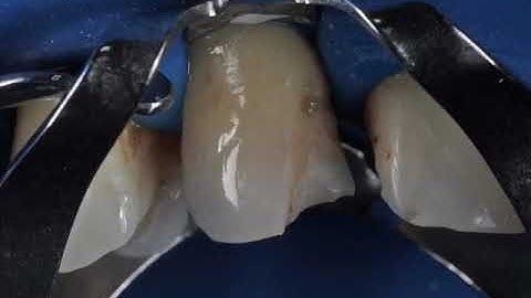 Class 4 Direct Composite Restoration | New Matrix Technique