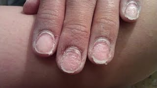 видео Как восстановить ногти после наращивания: лечение и укрупление