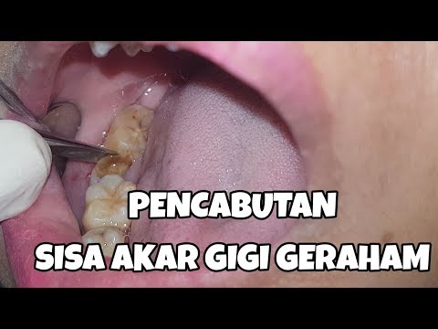 Video Mematikan Saraf Gigi Yang Sering Sakit