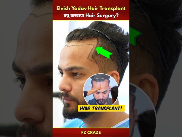 Elvish Yadav Hair Transplant Surgury Video😯 | @ElvishYadavVlogs Hair Transplant #trending #shorts class=