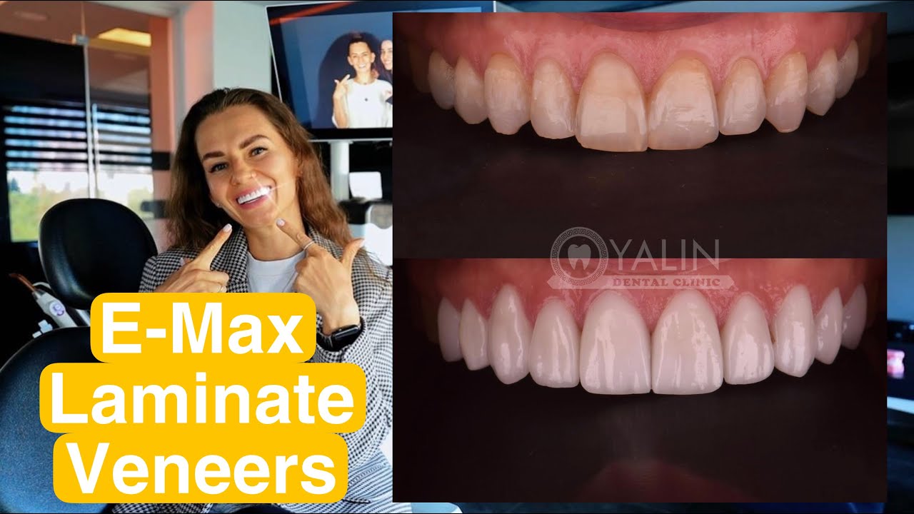 EMAX LAMINATE VENEERS TURKEY ANTALYA SMILE MAKEOVER YouTube