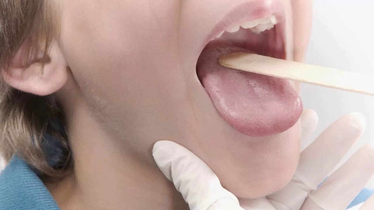 Какие симптомы инфекционного мононуклеоза