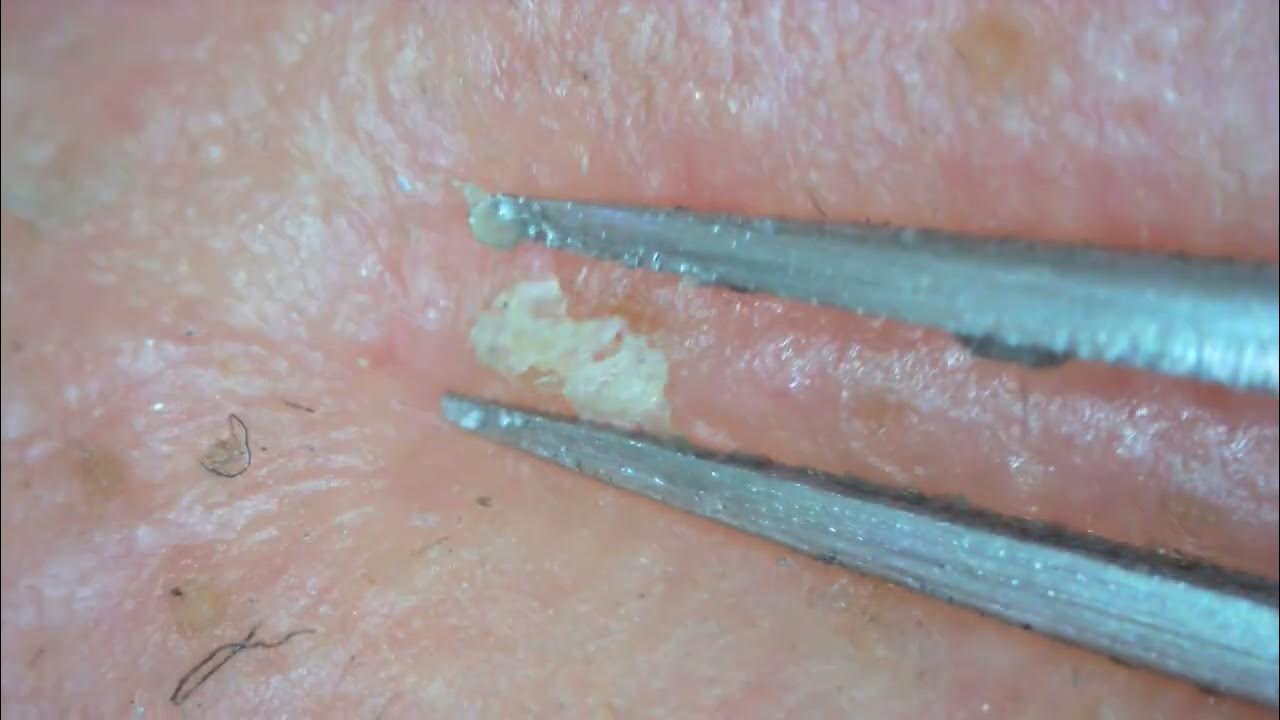 0258 keratin plug removal nose YouTube