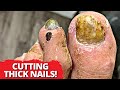 THICK Nail Debridement On World Traveling Consultant!