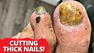 THICK Nail Debridement On World Traveling Consultant!