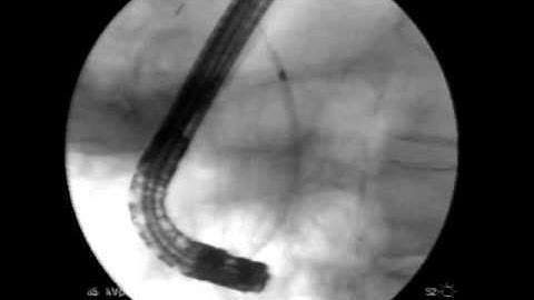 Clip số 3: Đưa stent đường mật vào ống mật chủ