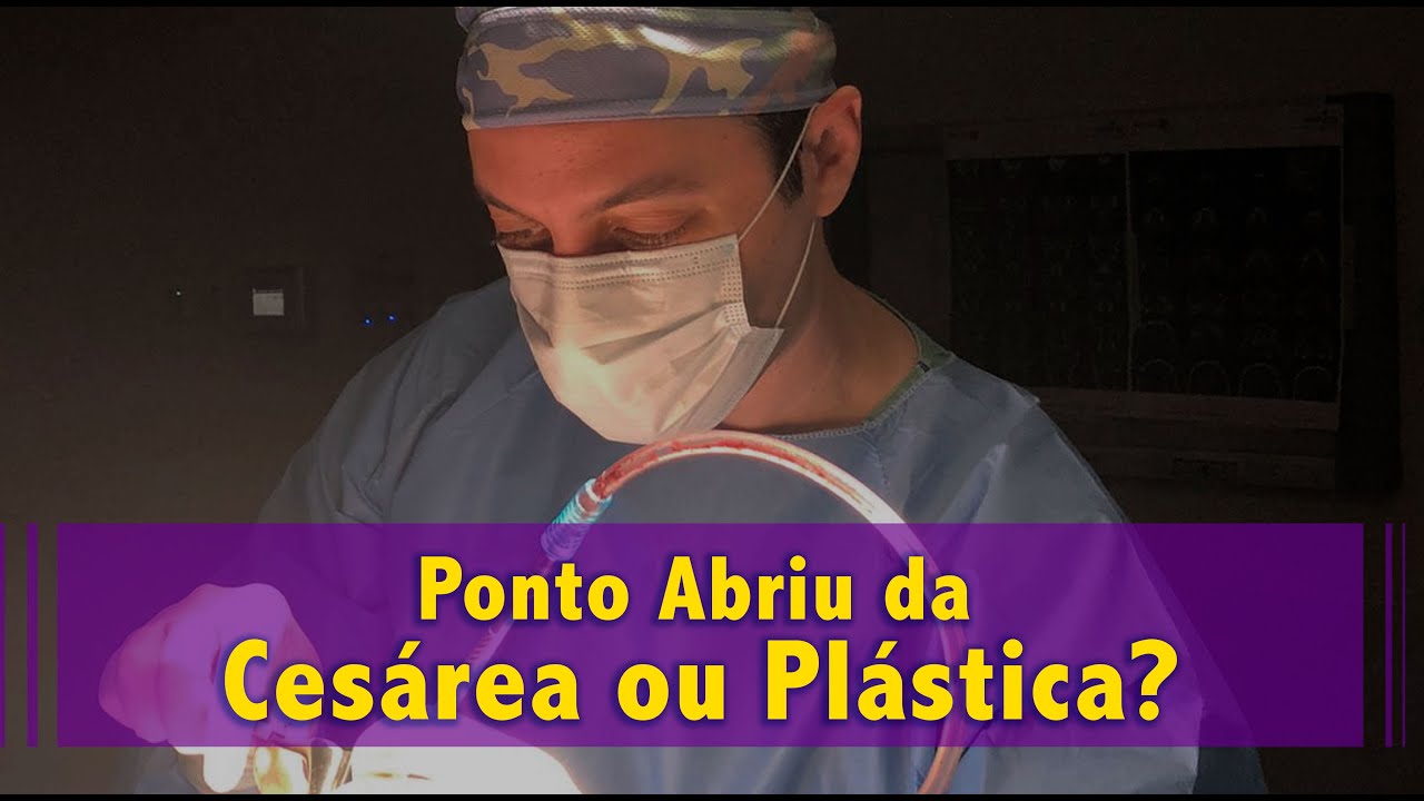 Ponto Abriu da cesárea ou plastica - YouTube