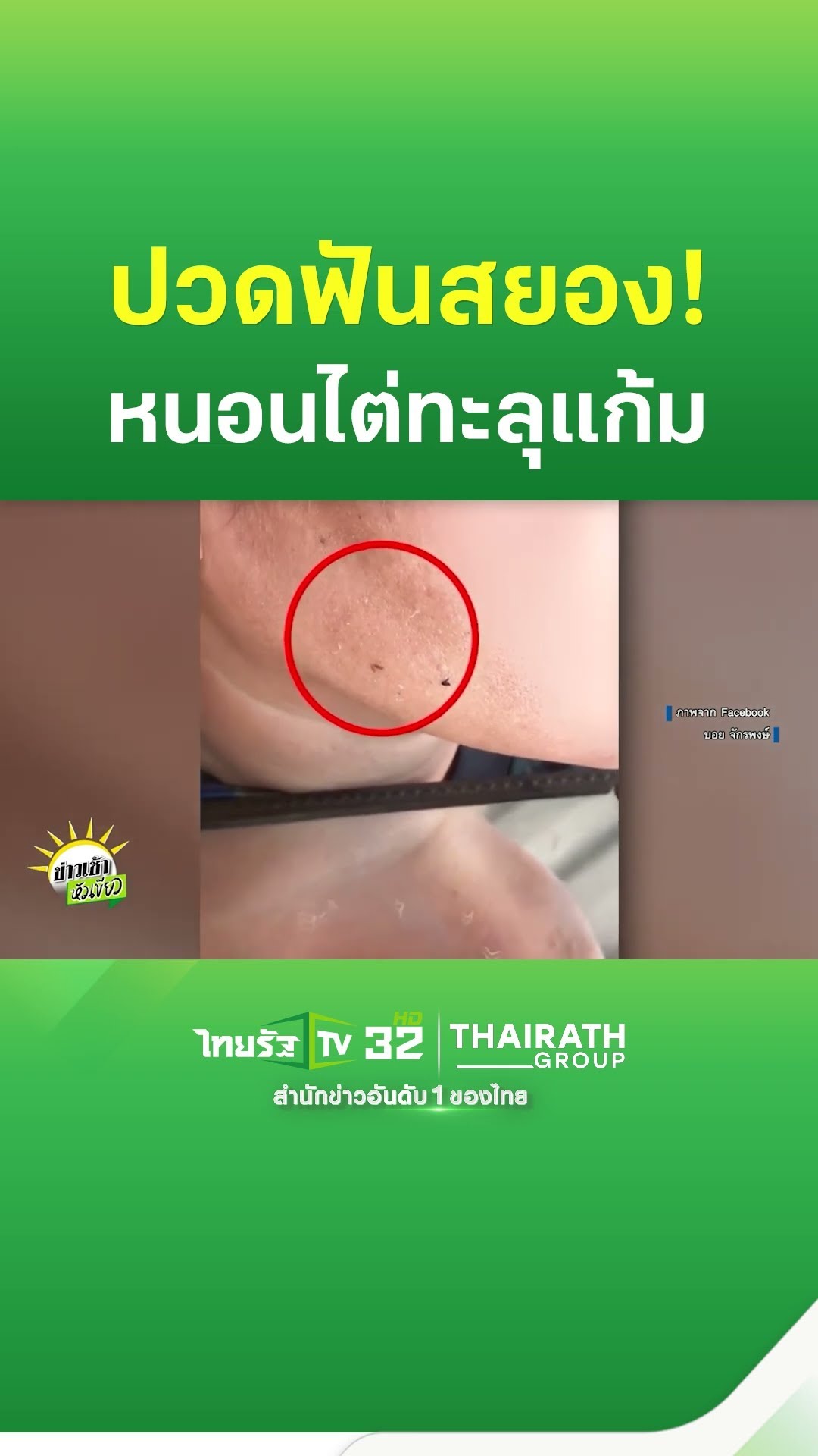 ใช่แน่นะ! ปวดฟันสยอง หนอนไต่ทะลุแก้ม | ThairathTV